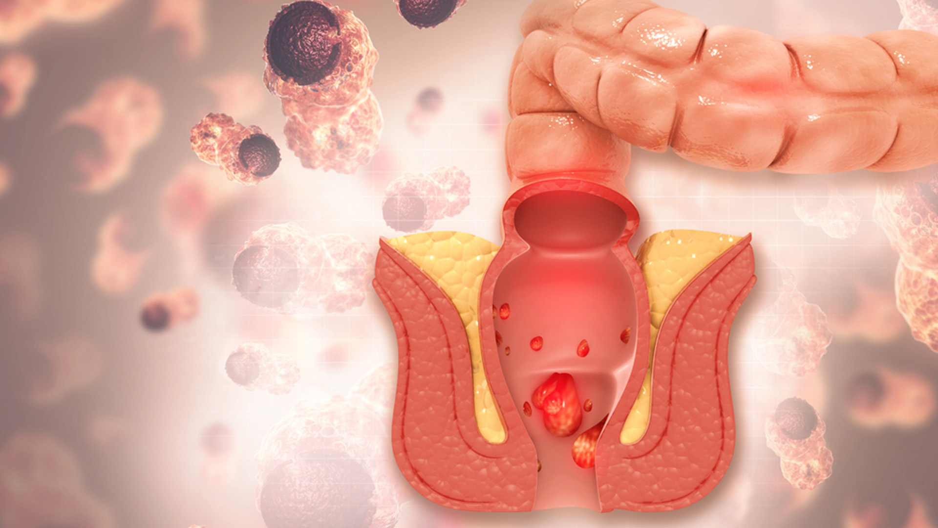 Anal Fissür (Makat Çatlağı)