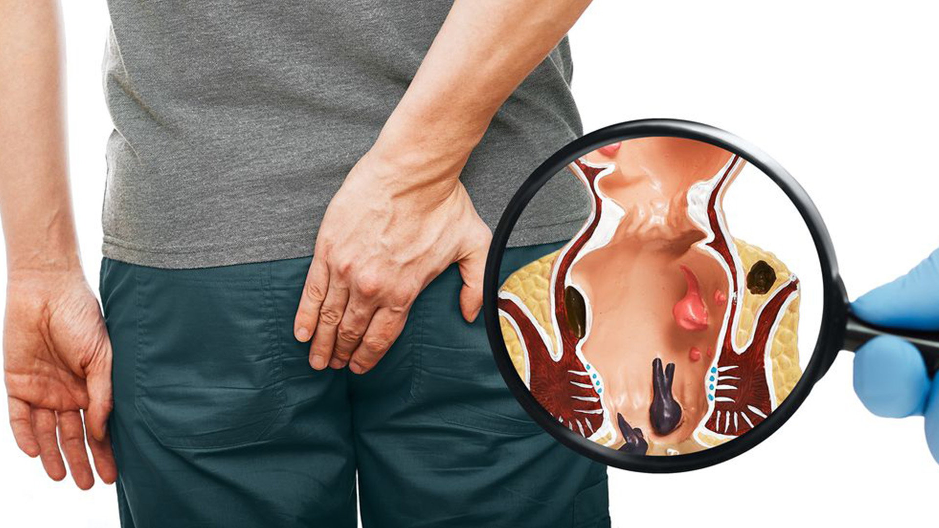 İnfrared Koagülasyon ile Hemoroid Tedavisi